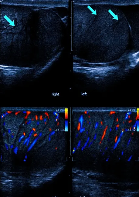 Яички (верхний ряд изображений) и интратестикулярный кровоток (цветовое допплеровское картирование внизу) на сонограммах при отсутствии патологии
