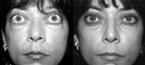 Лицо женщины с тиреотоксикозом до и после лечения