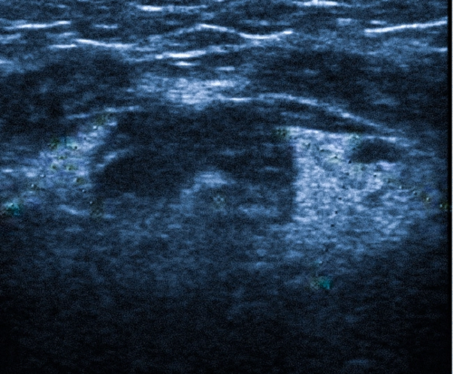 Гиперплазия левой подъязычной железы на ультрасонограмме