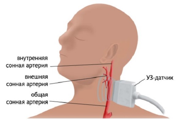 Схема получения сигналов от сонных артерий в процессе УЗДГ