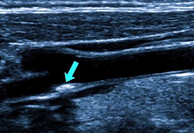  Сонограмма: атеросклеротическая бляшка (стрелка)