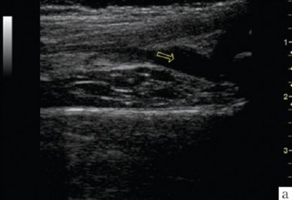 Стрелкой на УЗ-изображении указаны признаки синовита коленного сустава