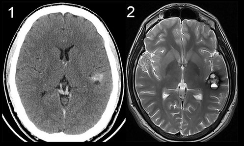 Патологические изменения головного мозга на снимках КТ (1) и МРТ (2)