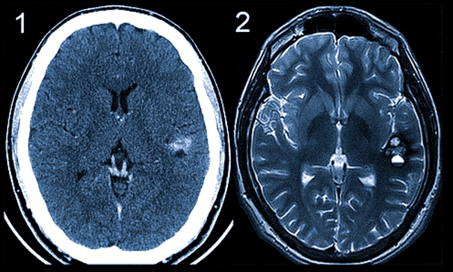 Патологические изменения головного мозга на снимках КТ (1) и МРТ (2)