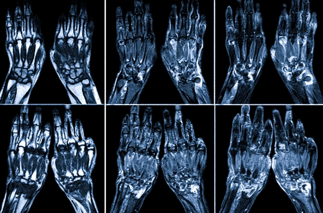  Лучевая диагностика ревматоидного артрита