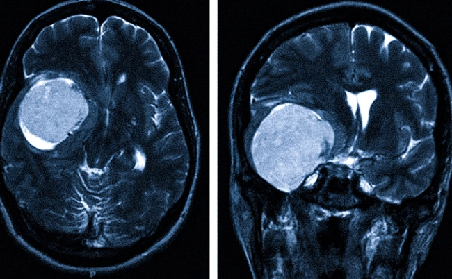 Менингиома на снимке МРТ