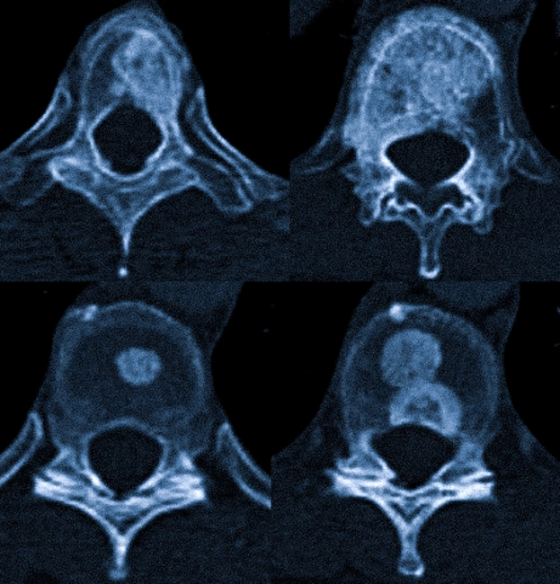 Множественные остеобластные метастазы грудных позвонков