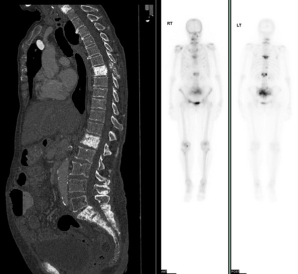 КТ и ПЭТ-исследование: визуализация остеосклеротических метастазов в позвонках и костях таза