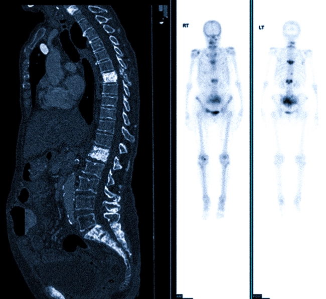 КТ и ПЭТ-исследование: визуализация остеосклеротических метастазов в позвонках и костях таза