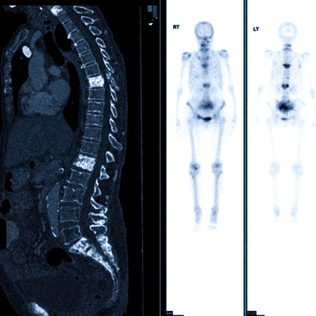 Видит ли КТ метастазы в костях