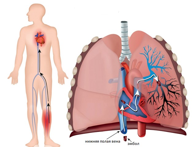 Схематическое изображение распространения тромбоэмбола из глубоких вен нижних конечностей в легочную артерию
