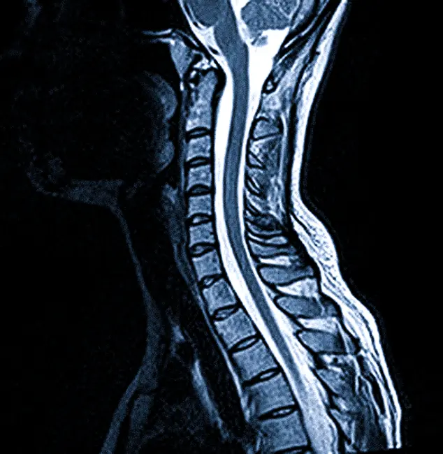 МРТ шейного отдела позвоночника
