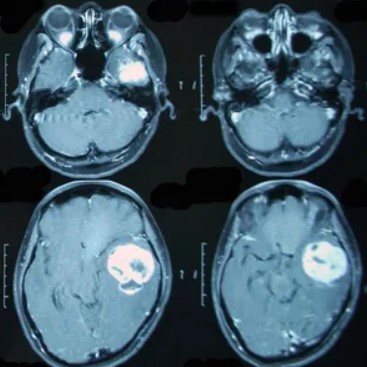 Виды МРТ головного мозга