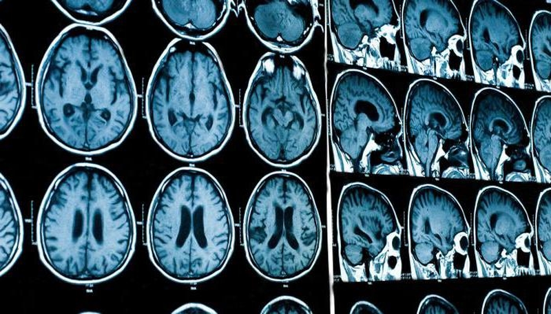 Снимки головного мозга на МРТ