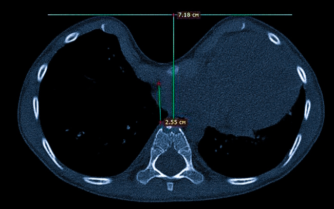 Воронкообразная грудная клетка на КТ