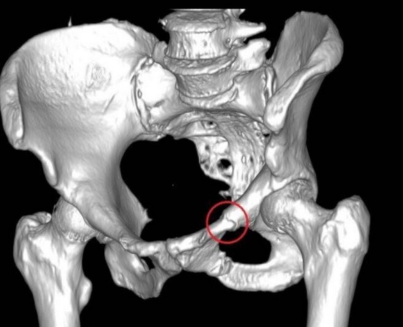 На КТ-снимке в режиме объемной визуализации выявлен перелом лонной кости 