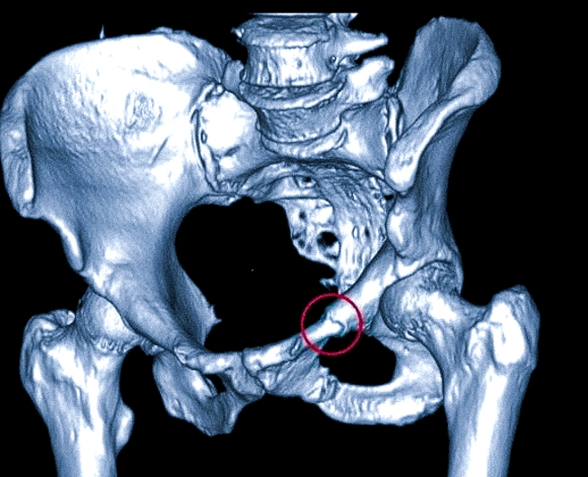 На КТ-снимке в режиме объемной визуализации выявлен перелом лонной кости 