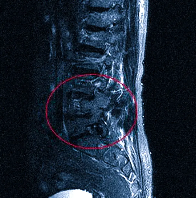 опухоль на МРТ позвоночника