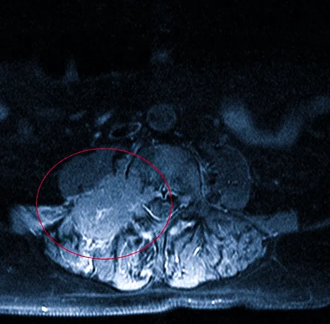 Паравертебральное образование на МРТ