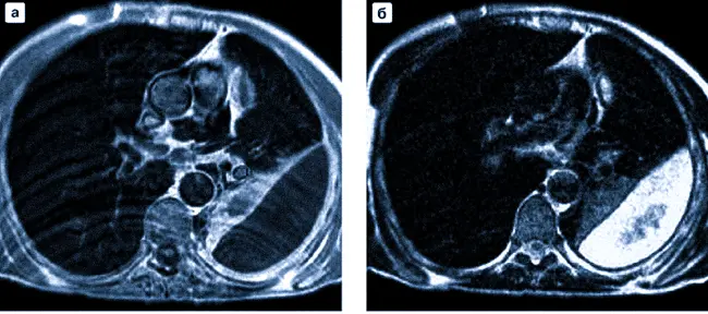 Эмпиема плевры на МРТ