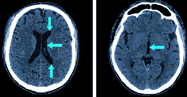 Желудочки мозга на КТ