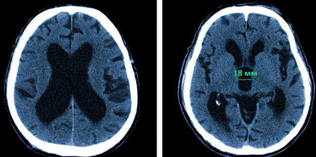 Желудочки мозга на КТ