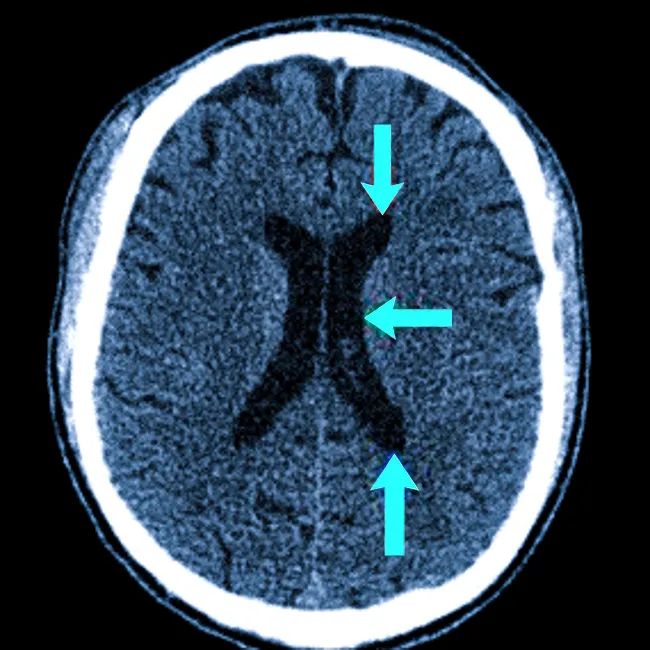 Желудочки мозга на КТ