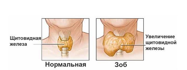 Зоб щитовидной железы на КТ