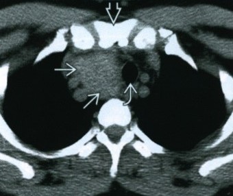 Зоб щитовидной железы на КТ