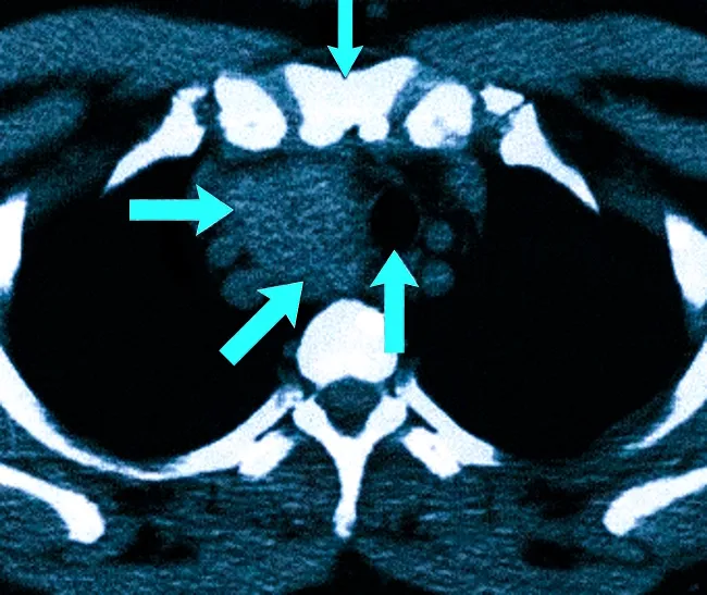 Зоб щитовидной железы на КТ