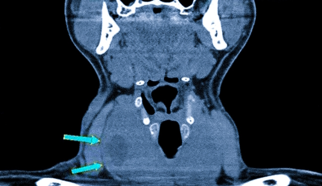 Зоб щитовидной железы на КТ