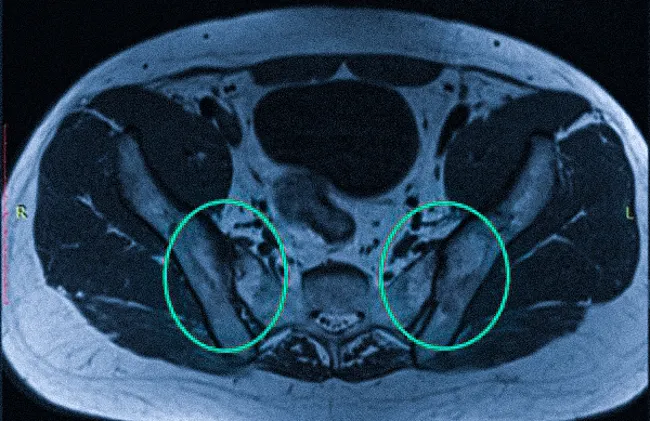 МР-скан на уровне костей таза