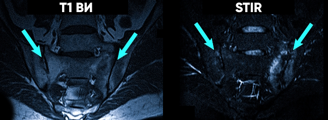 Сакроилеит на МРТ