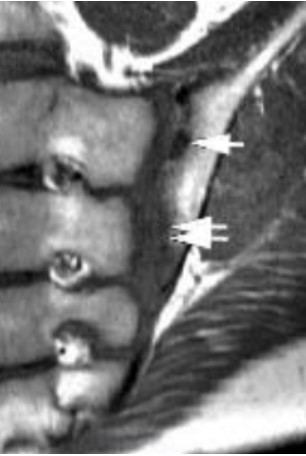 МР-изображение сакроилеита 